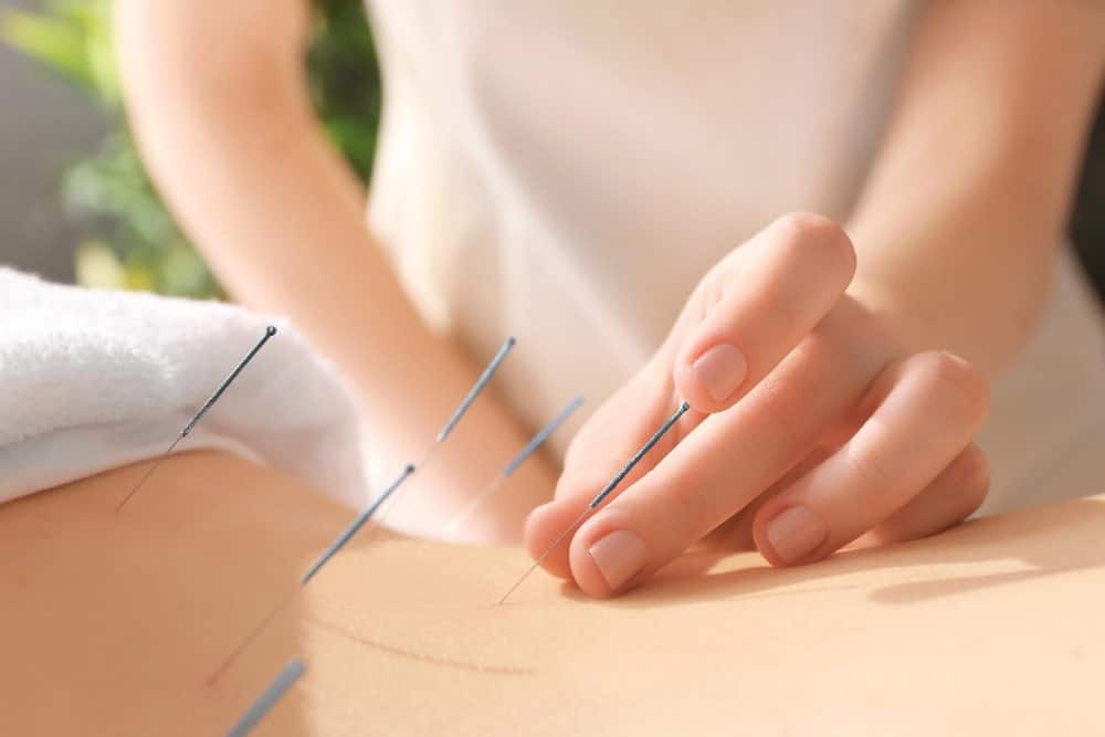 mujer haciendo acupuntura